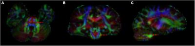 A preliminary study of diffusion tensor imaging in root entry zone of primary trigeminal neuralgia